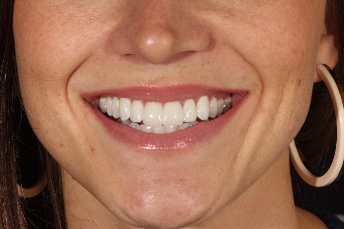 after cosmetic dentistry