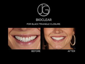 Patient before and after Bioclear in Plano, TX