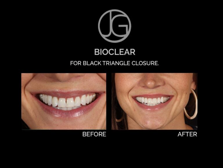 Patient before and after Bioclear in Plano, TX