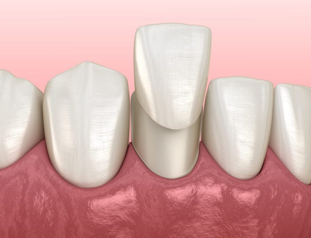 Porcelain Veneers in Plano, Texas