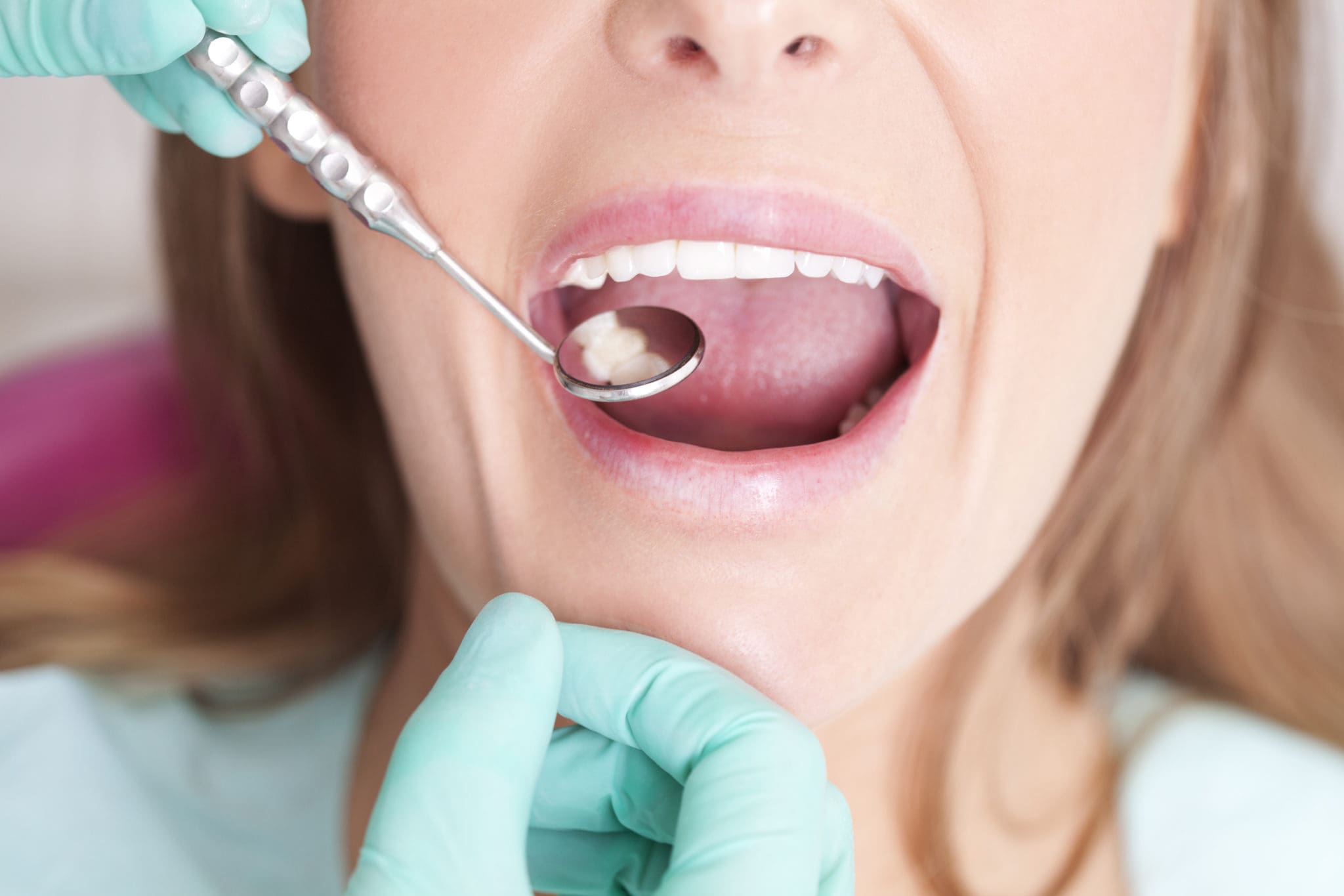 Safely Replacing Metal Dental Fillings Dentist in Plano, TX