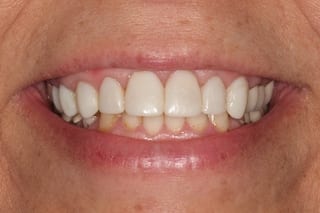 After cosmetic dentistry