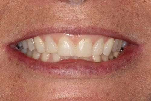 After cosmetic dentistry