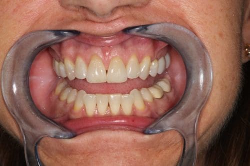 Before cosmetic dentistry