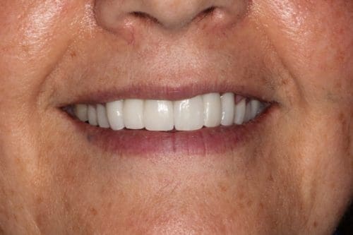 After cosmetic dentistry