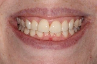 After cosmetic dentistry