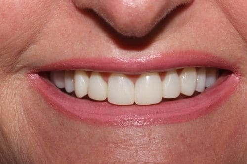 After cosmetic dentistry