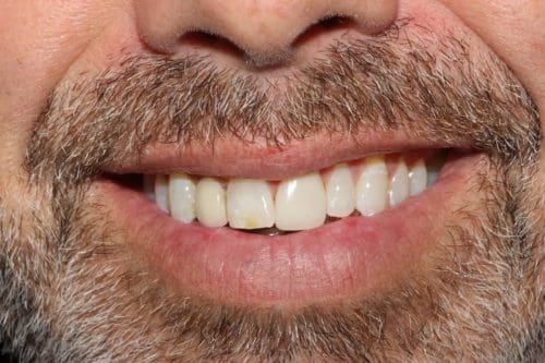 After cosmetic dentistry