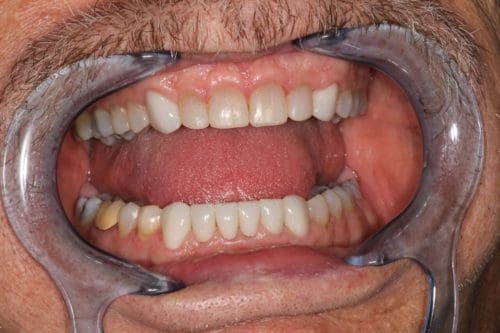 After cosmetic dentistry