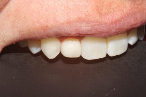 After cosmetic dentistry