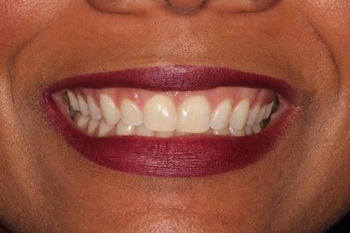 After cosmetic dentistry