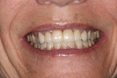 After cosmetic dentistry