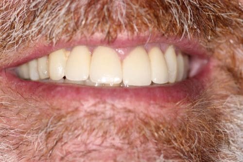 After cosmetic dentistry