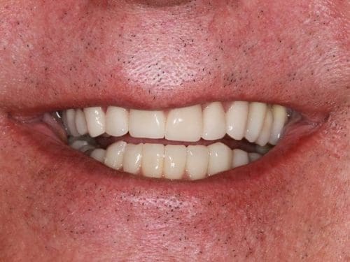 After cosmetic dentistry