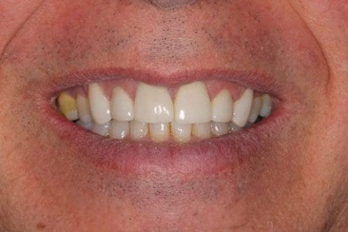 After cosmetic dentistry