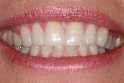 Before cosmetic dentistry