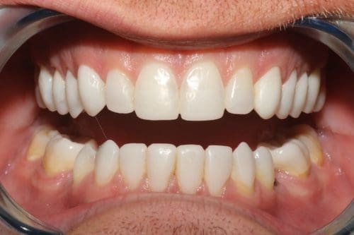 After cosmetic dentistry