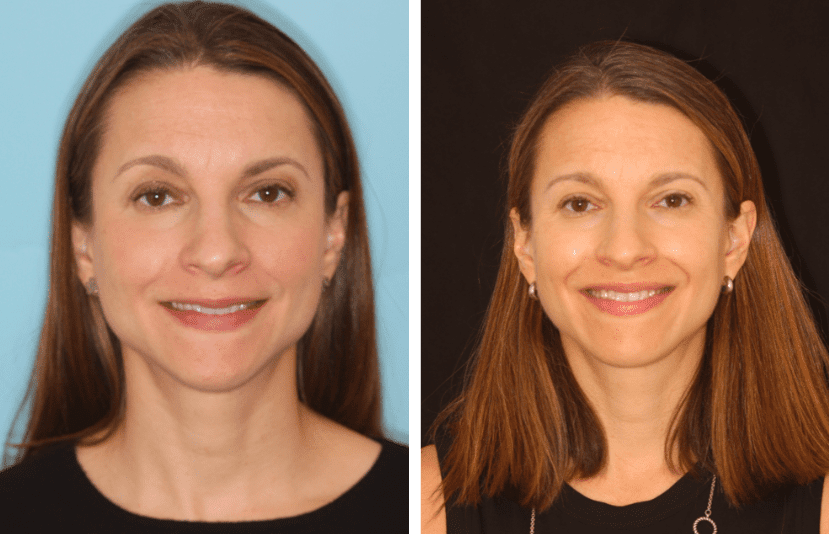Before and after TMJ treatment from Dr. Grapevine
