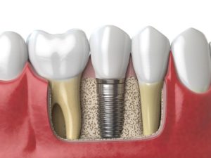 preserve jawbone with single dental implant tooth replacement