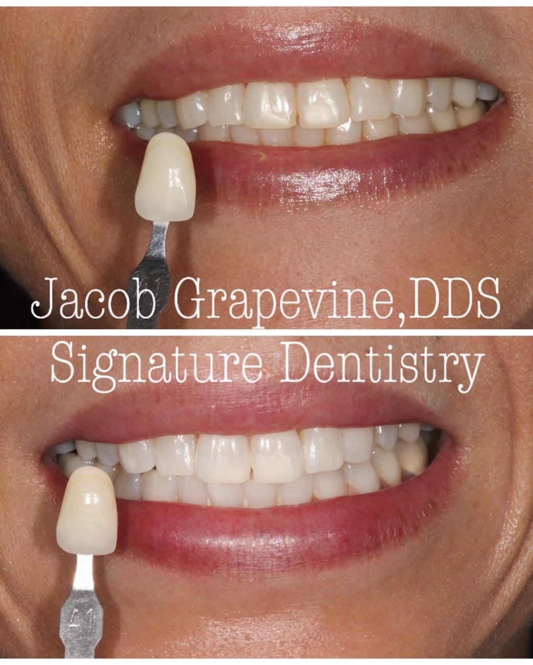 Dental patient before and after no-prep veneers