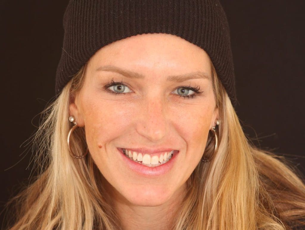 Before teeth whitening