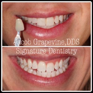 Teeth Whitening in Plano TX