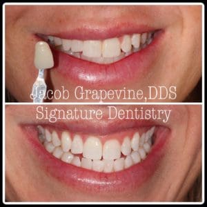 Teeth Whitening Plano TX