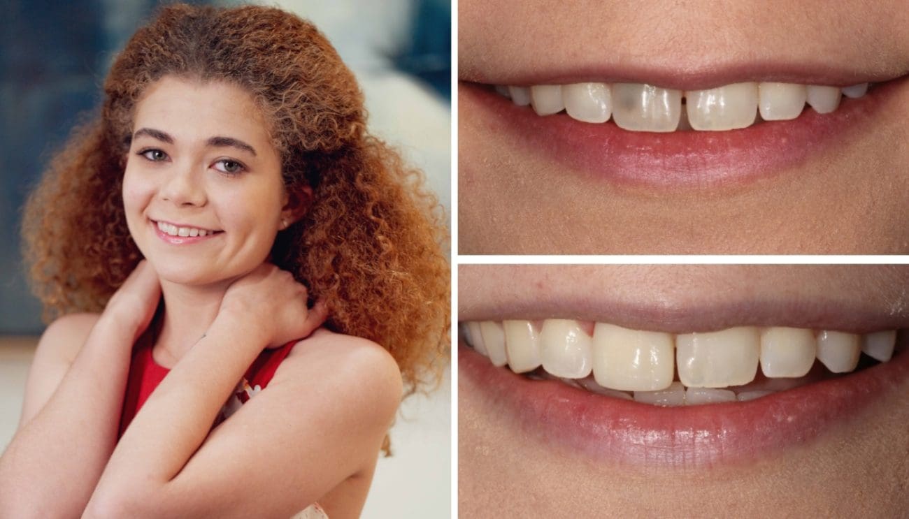 Teeth bonding in Plano