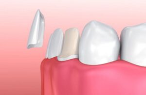 How to Maximize Porcelain Veneers Benefits