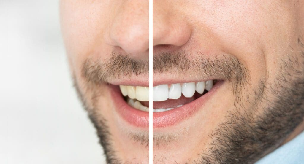 Affordable teeth whitening treatments in Plano Texas