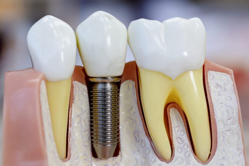 Cost of Dental Implants in Plano, TX