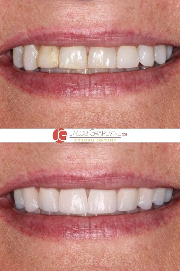 Dental patient before and after porcelain veneers