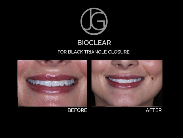 Bioclear can close triangles in your teeth