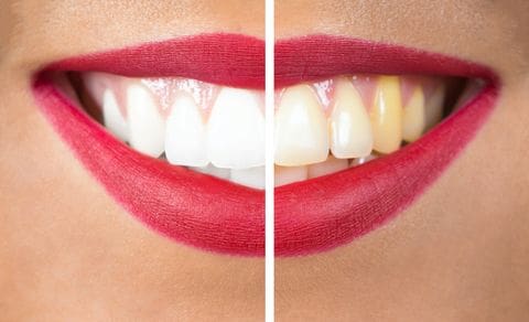 Different Types of Tooth Stains