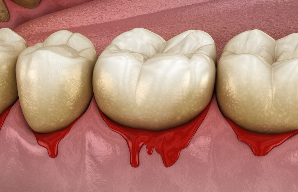 Gum disease remains a prevalent issue that impacts many individuals, but preventative care could help manage symptoms.