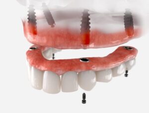 An implant denture is a modern and effective solution to tooth loss