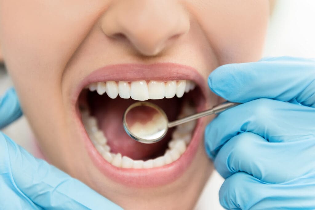 Tooth Cavity in Plano TX
