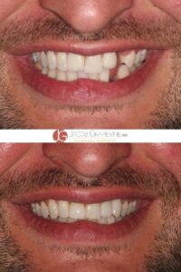 before and after dental implants