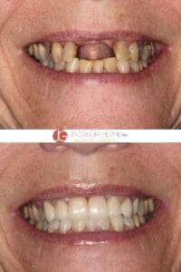 before and after dental implants for front teeth