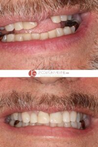 before and after single dental implant