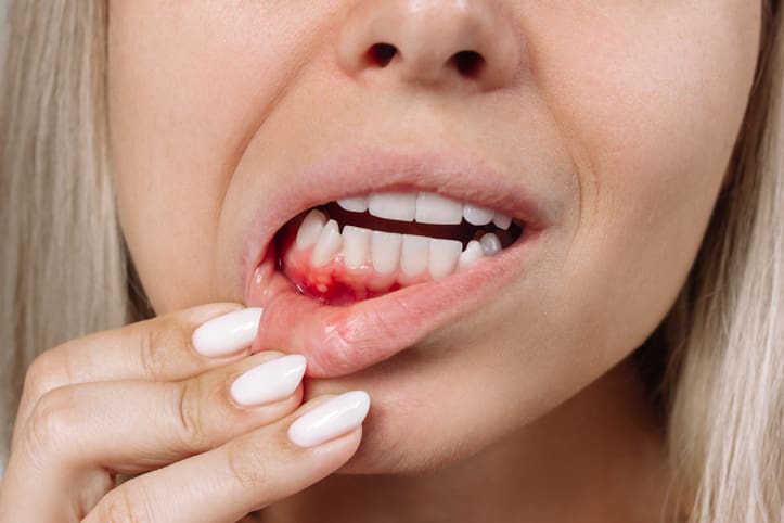 bleeding gums treatment in Plano TX