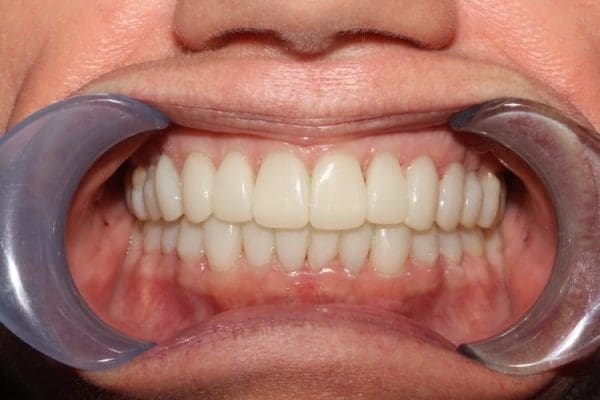 after-composite-600x400