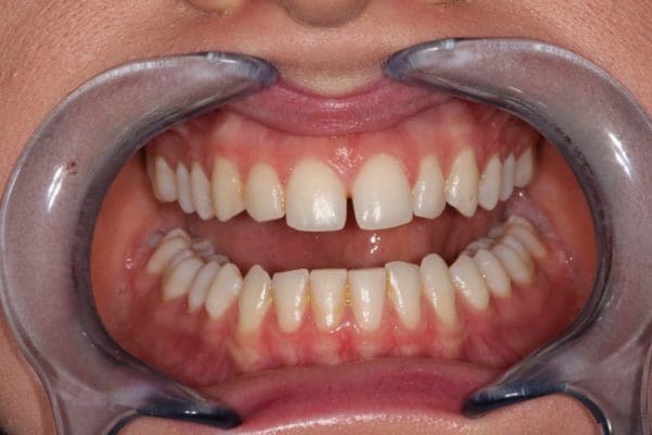 before-bonding-retracted-600x400