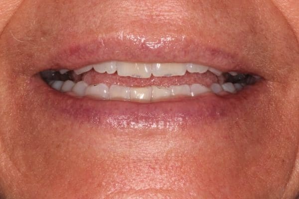 before-composite-3--600x400