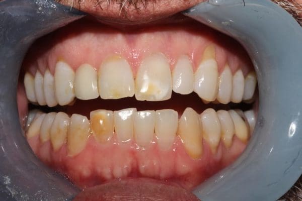 before-composite-veneer-600x400