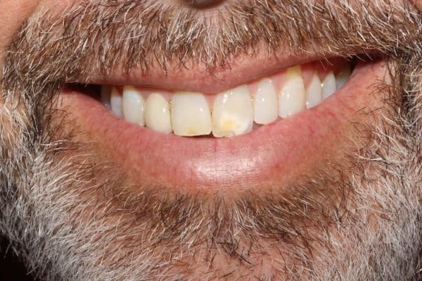 before-composite-veneer-smile--600x400