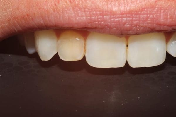 before-dark-tooth--600x400