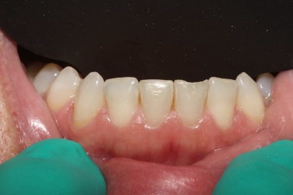 black-triangle-before-bioclear-600x400