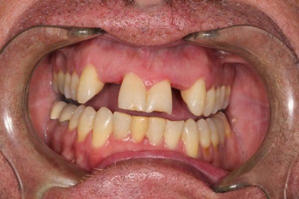 implantandcrownsbefore-3-600x400