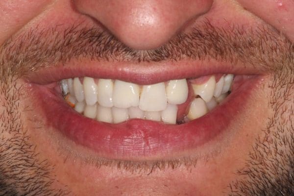 implantcrownbefore-600x400